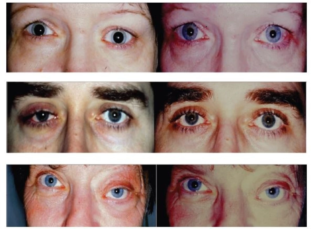 Clinical picture before determination of histological diagnosis (right) and condition after pacification following external orbitotomy (left) in patients with inflammatory pseudotumour of the lachrymal gland. Top case report no. 1, middle case report no. 2, bottom case report no. 3