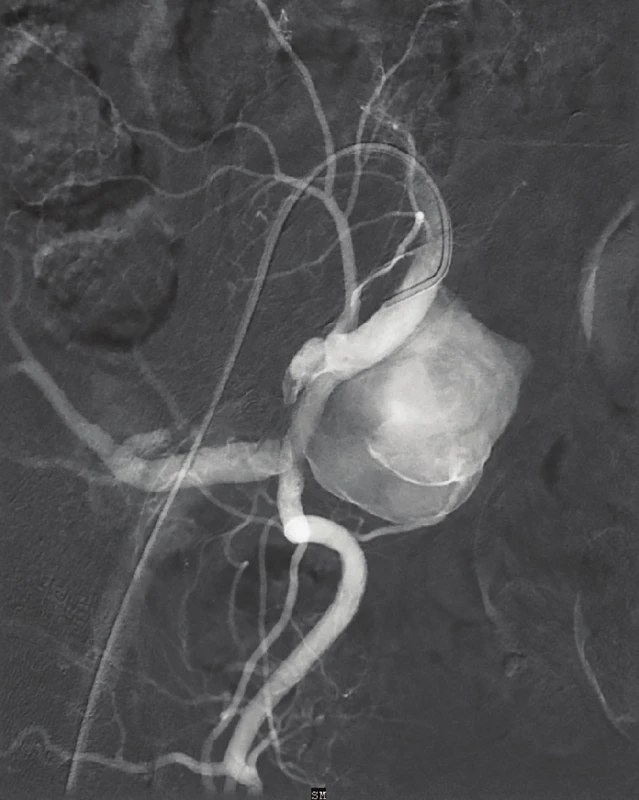 Digitální subtrakční angiografie – vak aneuryzmatu
v odstupu a.glutea superior<br>
Fig. 2: Digital subtraction angiography – hypogastric artery
aneurysm on the level of the superior gluteal artery