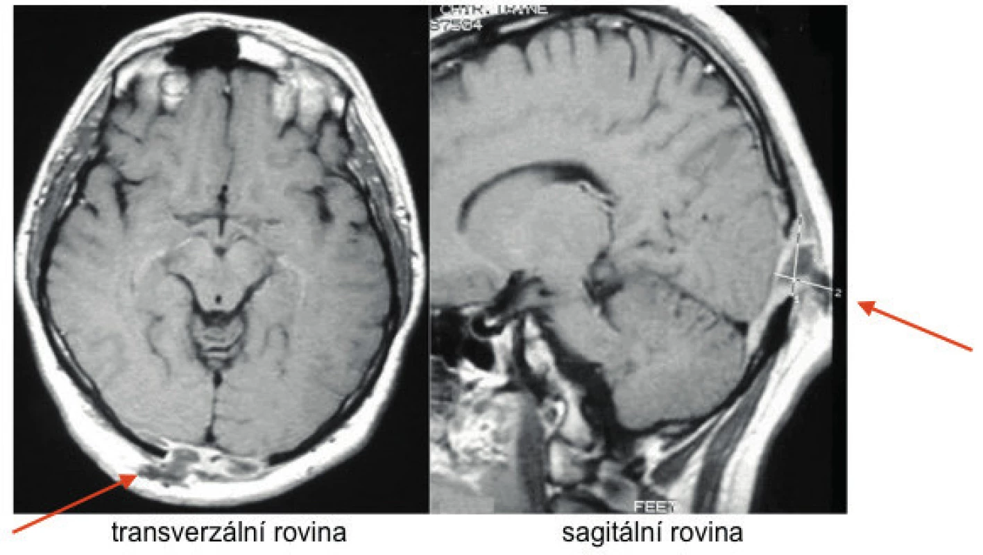 LCH postihuje velmi často lebeční kosti, ale může postihnout
kteroukoliv kost v těle<br>
Kostní ložiska LCH mají osteolytický charakter, na rozdíl od podobných
osteolytických ložisek u mnohočetného myelomu, u LCH tumorózní
hmoty častěji expandují do okolí kosti a způsobují hmatné zduření,
pokud expandují zevně, anebo neurologické či oční příznaky, pokud
tumorózní hmoty komprimují mozek i obsah očnice. Na obrázku je
zřetelný osteolytický proces okcipitálně, který expandoval jak vně kosti,
takže pacient udával v tom místě hmatné zduření, tak také expandoval
do nitra kalvy a komprimoval šedou koru mozkovou v oblasti zrakového
centra, což se projevilo poruchou zraku. Po léčbě kladribinem se vše
upravilo a pacient je více než 10 let v remisi. K podobné osteolýze
s expanzí zevně i dovnitř může dojít v kterékoliv lebeční kosti.