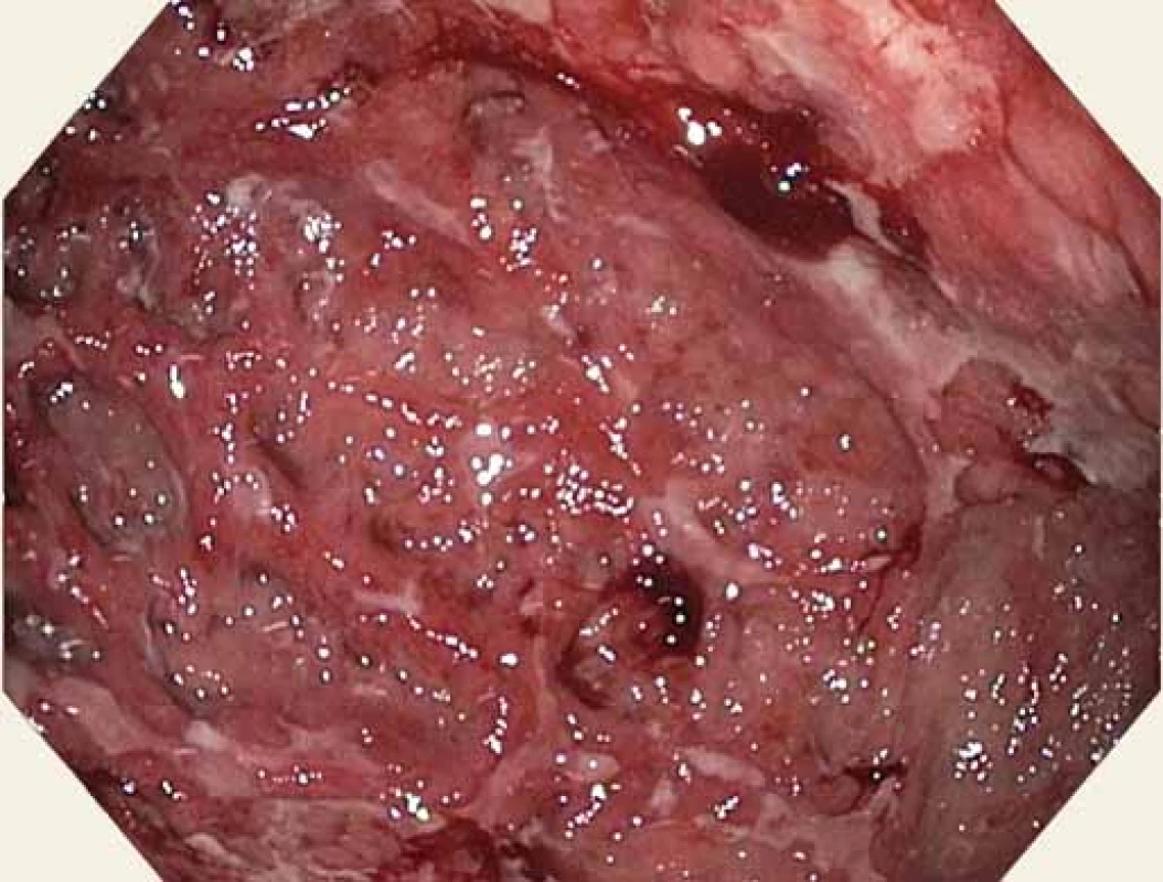 Sliznice žaludku – tělo – ploché ulcerace s fibrinovými
povlaky, přechodné spontánní krvácení.<br>
Fig. 4. Gastric mucosa – body – flat ulcerations with fibrin
coatings, transient spontaneous bleeding.