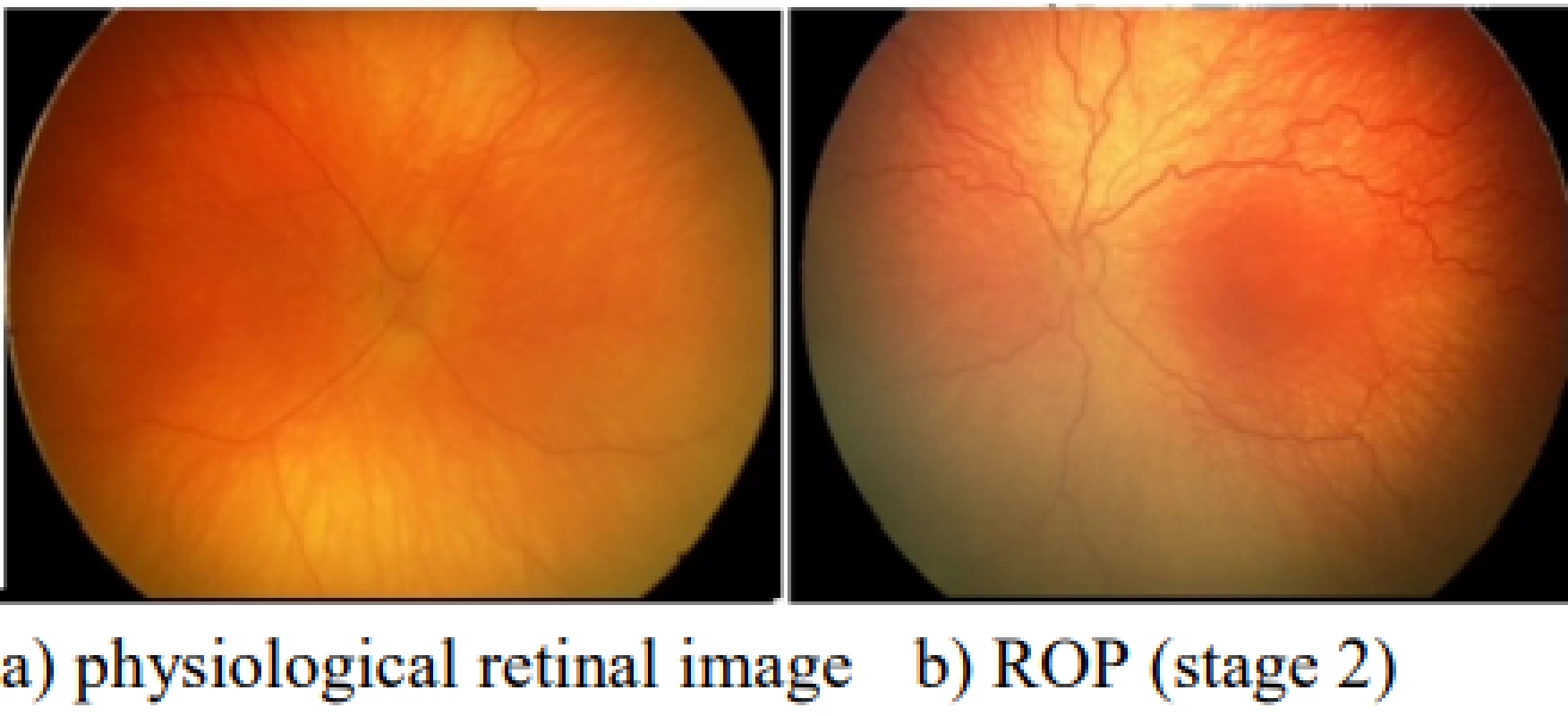  a) Retinal image with physiological blood
vessels, b) retinal image with ROP (stage 2) with
tortuosity