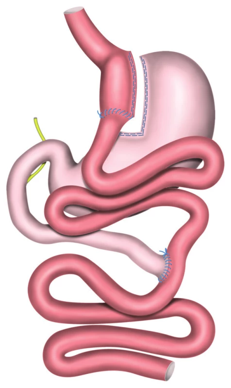 RYGB − Roux Y gastrický bypass<br>
Fig. 1: RYGB − Roux-en-Y Gastric Bypass