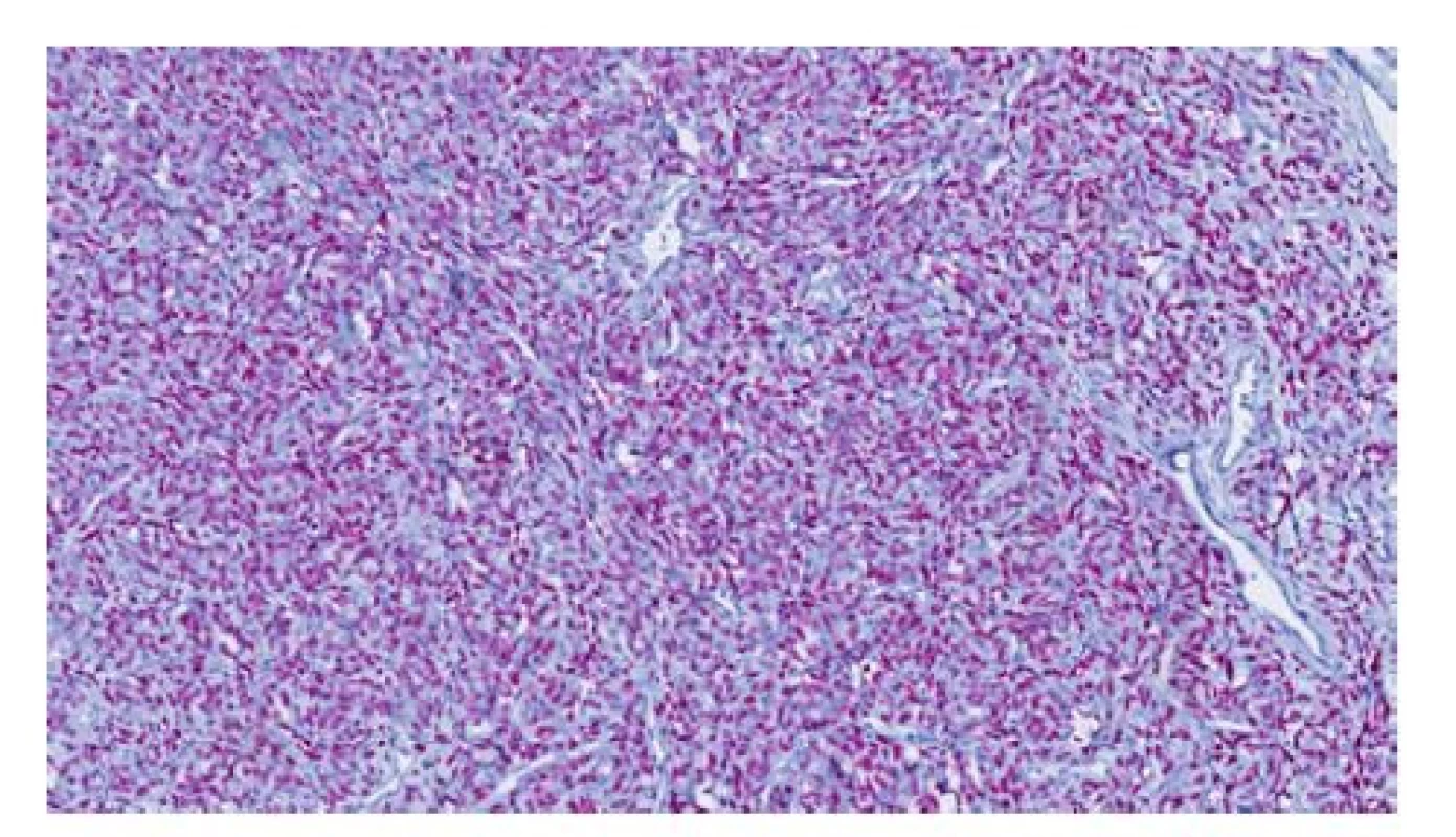 Nukleární exprese STAT6 v nádorových buňkách,
diagnostický imunofenotyp SFT<br>
Fig. 2. Nuclear expression of STAT 6 in tumor cells,
diagnostic imunophenotype of SFT
