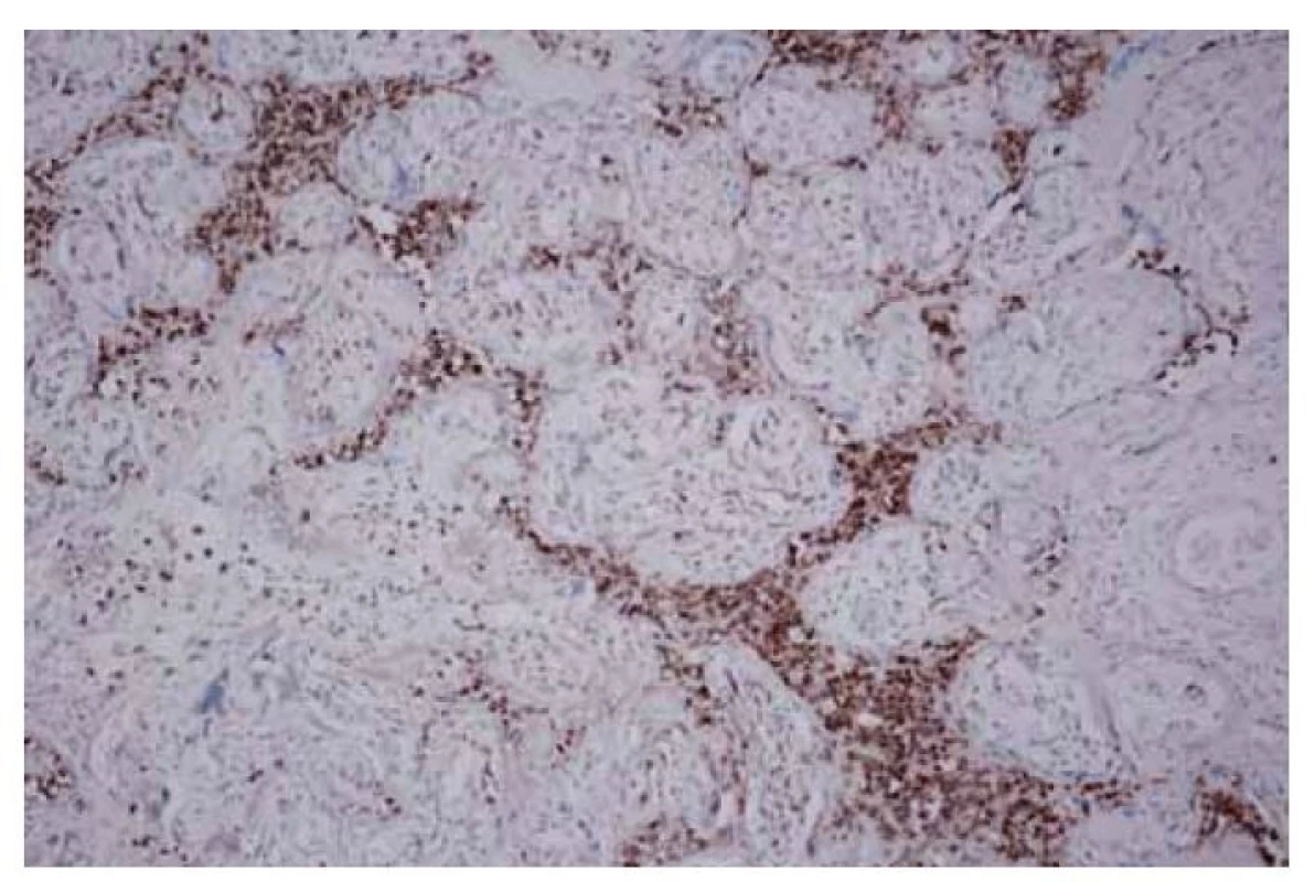 Imunohistochemický průkaz histiocytů v zánětlivém infiltrátu
(CD68, 200x).<br>
Fig. 5. Immunohistochemical detection of histiocytes in the inflammatory infiltrate
(CD68, 200x).