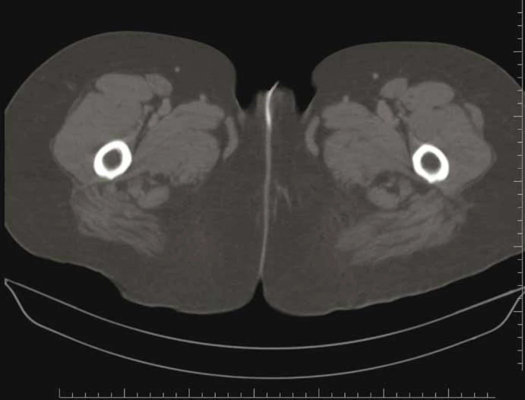 Sagittal abdominal CT.<br>
Obr. 2. Sagitální abdominální CT.