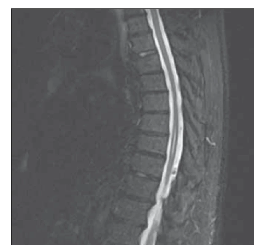 MR hrudní páteře – T2 TIRM vážený
obraz: rozšíření centrálního míšního kanálku
v segmentech Th 7–8.<br>
TIRM – turbo inversion recovery magnitude<br>
Fig. 1. MRI of thoracic spine T2 – TIRM
weighted image: widening of the central
spinal canal in the segments Th 7–8.<br>
TIRM – turbo inversion recovery magnitude