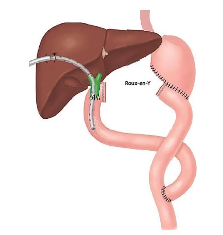 CDS se zavedeným PTD po Roux-Y gastrektomii<br>
Fig. 2: CDS with PTD after Roux-Y gastrectomy