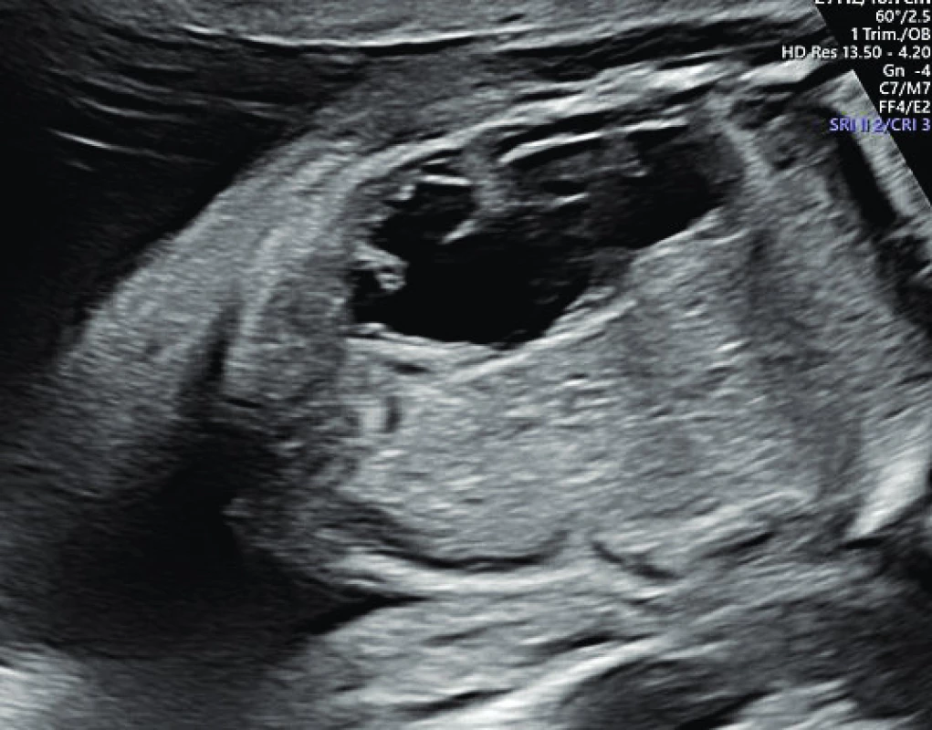 Fetální hydronefróza.<br>
Fig. 4. Fetal hydronephrosis.
