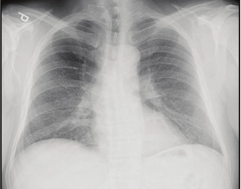 Skiagram hrudníku: mnohočetná drobná
nodulární zastínění<br>
Fig. 1. Chest X-ray: small and multiple pulmonary
miliary nodules