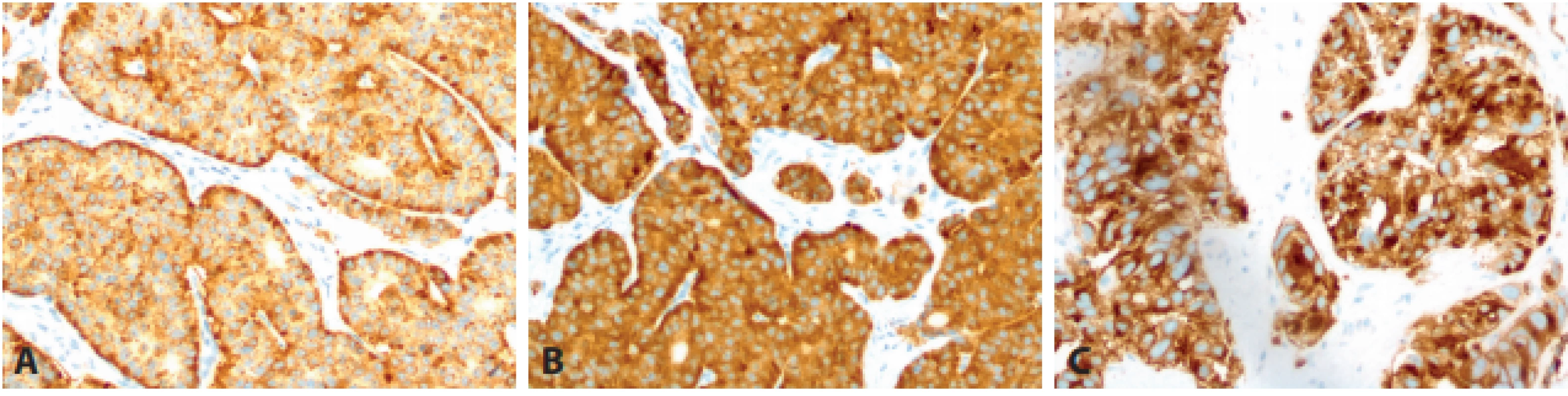 Základní imunohistochemické reakce u neuroendokrinních neoplázií (NEN). 