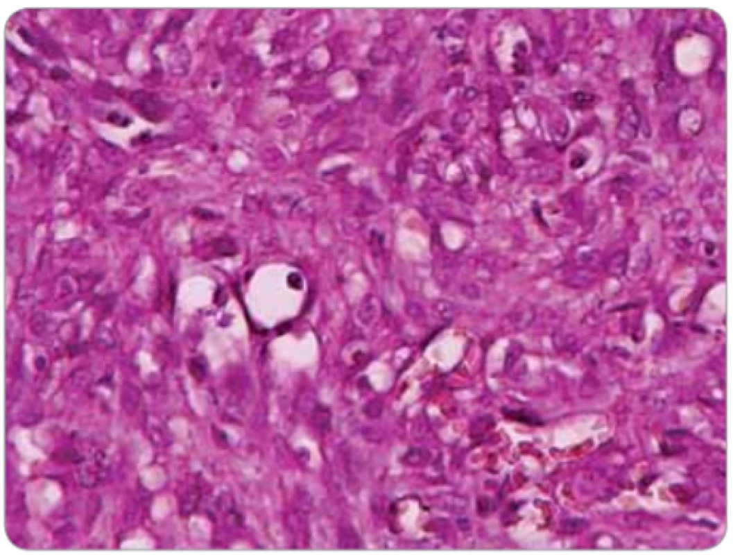 Spindle cells with swollen nuclei with some cytonuclear
atypia and few mitotic fi gures.