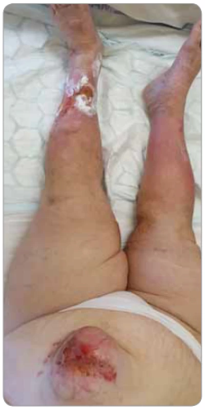 Pacientka s onkologickou ránou
v podobě exulcerované metastázy
karcinomu v břišní stěně a s nehojící se
bércovou ulcerací cévní etiologie (foto
S. Vokurka, FN Plzeň).