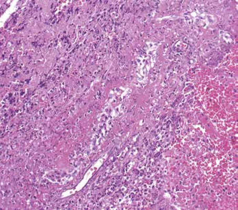 <b>Vaskulitida v biopsii z oblasti ORL.</b> Arterii bez nekrózy v dolní části snímku doprovází žíla s rozsáhlou fibrinoidní nekrózou stěny (šipky). Vpravo krvácení (barvení HE s elastikou).