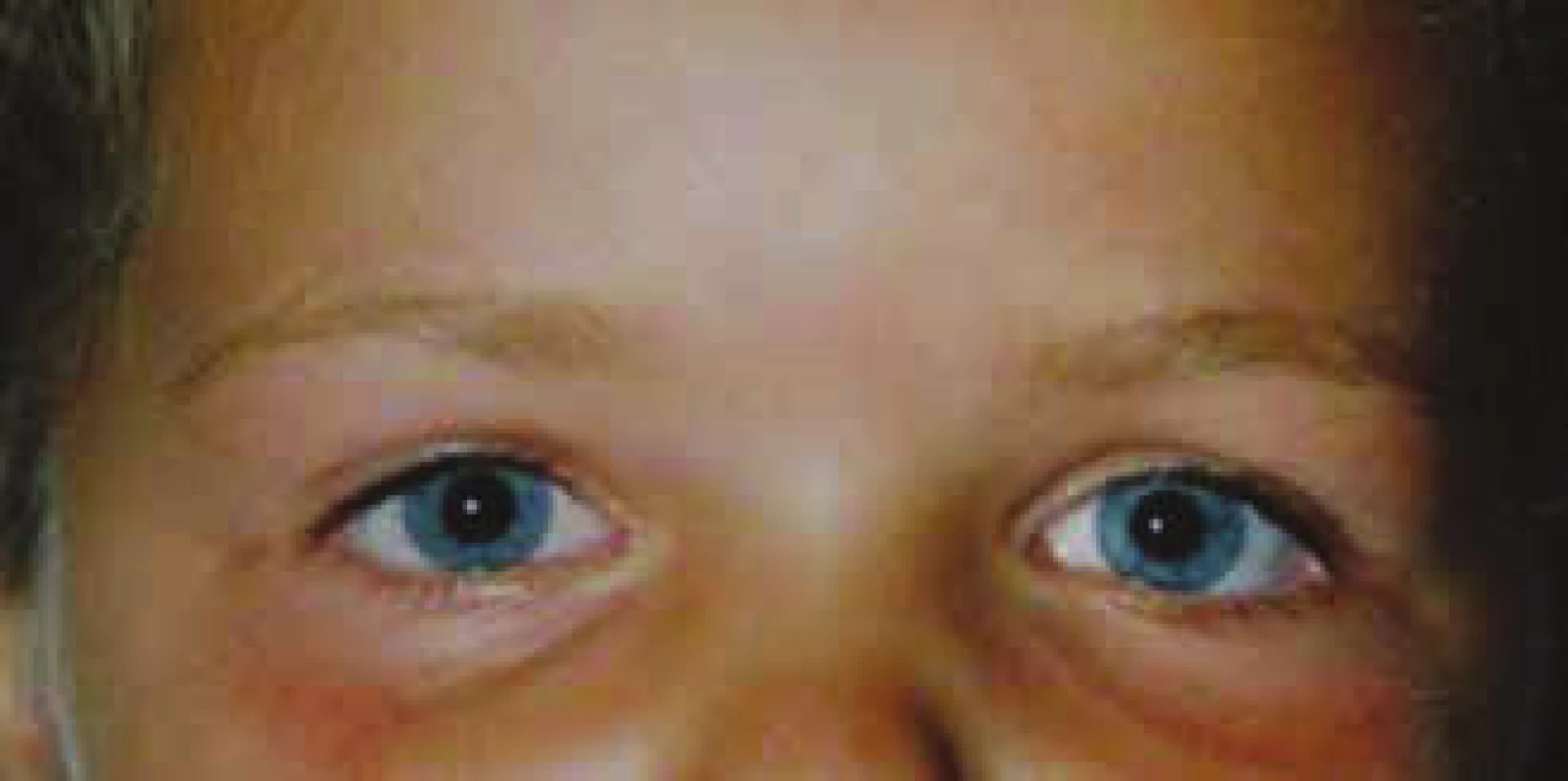 Normalisation of left pupil width at follow-up examination
of patient on second day