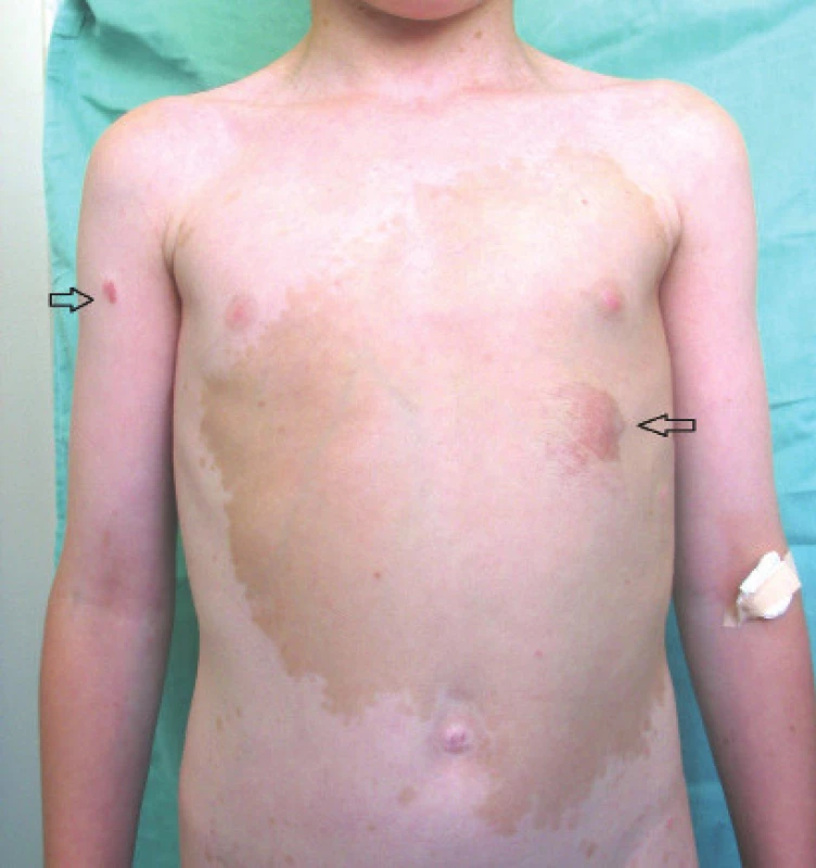 Plexiform neurofibroma<br>
Source: Paediatric Clinic, Faculty of Medicine, Masaryk
University and University Hospital Brno