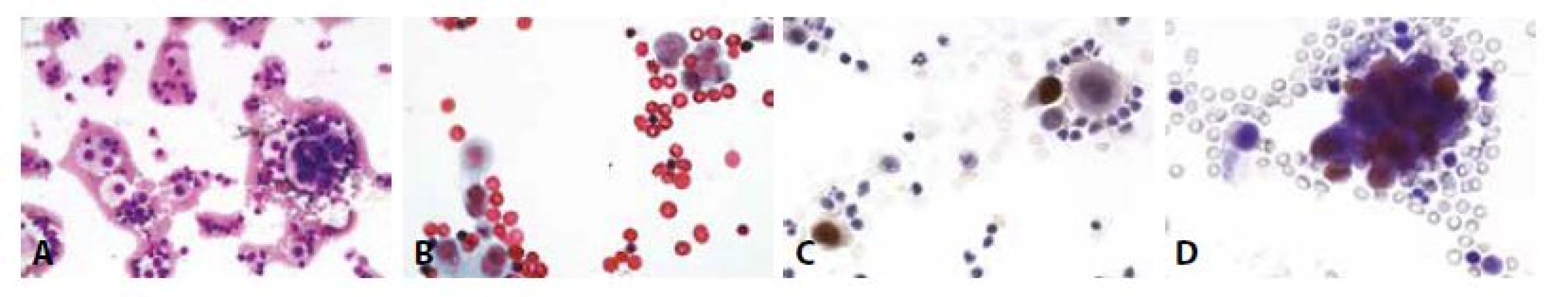 Příklady nejběžnějších karcinóz coelomových dutin: Žena 73 let, ablace prsu pro karcinom před 10 lety, chemo- a radioterapie. Pleurální punktát.