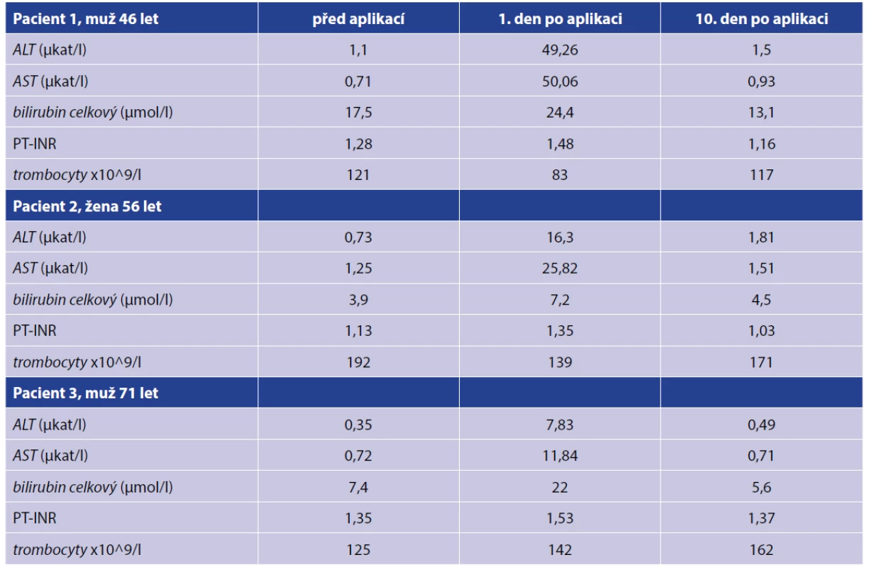 Laboratorní hodnoty před aplikací, 1 den po aplikaci, resp. 10 dní po aplikaci absolutního alkoholu<br>
Tab. 1. Laboratory findings before, 1 day after, and 10 days after absolute alcohol injection, respectively