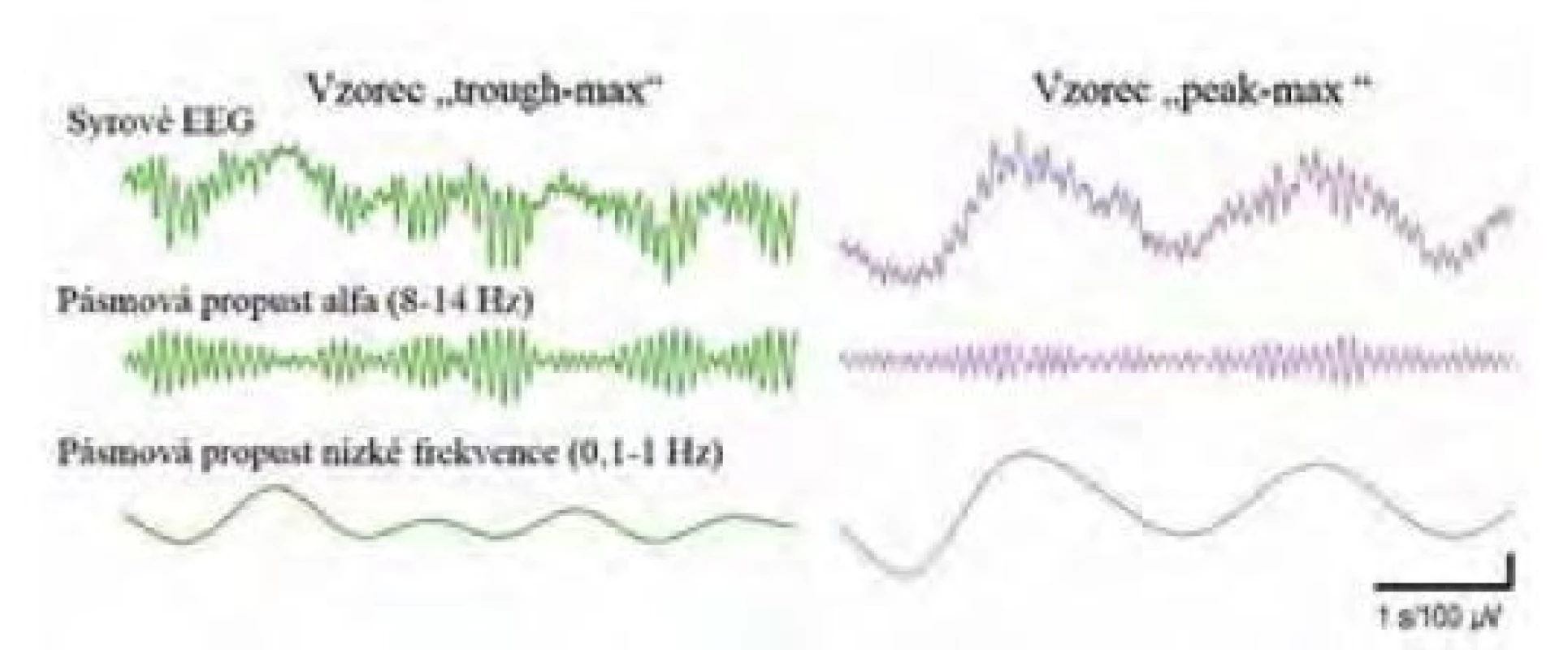 Dva odlišné vzorce vazby mezi fází a amplitudou (phase-amplitude
coupling). Vzorec „peak-max“ odpovídá chirurgické anestezii, amplituda
alfa oscilací je nejvyšší na vrcholech pomalých oscilací, kdežto „trough-max“,
u něhož je amplituda alfa oscilací nejvyšší v údolích pomalých oscilací, znamená
příliš mělkou, nebo naopak příliš hlubokou anestezii. Upraveno z [38]