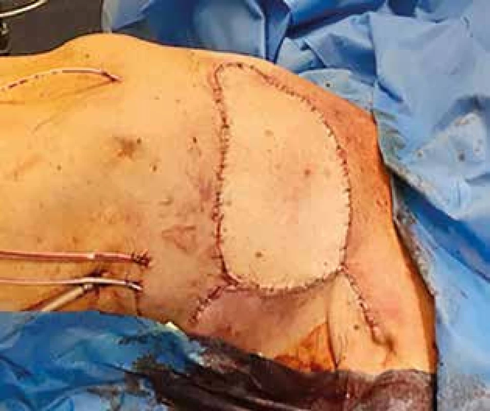 Stav po rekonstrukci defektu kombinovaným lalokovým posunem<br>
Fig. 4: Finding after plastic surgery reconstruction using
combined flaps technique