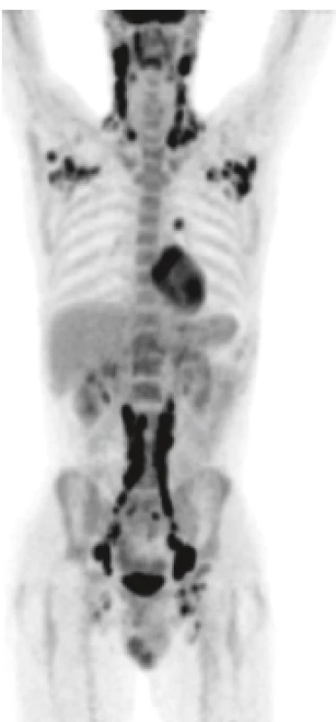 LCH může postihnout lymfatické
uzliny podobně jako u lymfomů<br>
PET-CT znázorňujě postižení lymfatických
uzlin od krku až po inguiny. LCH z tohoto
pacienta měla neobvykle vysoký proliferační
index a vysoký počet mitóz, onemocnění
se chovalo velmi agresivně, takže po remisi
navozené lenalidomidem byla provedena
alogenní transplantace krvetvorné tkáně
a pacient je nyní 8 let od transplantace
v remisi LCH.