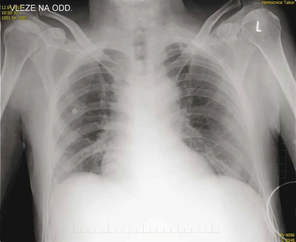 Vstupní RTG snímek hrudníku – normální nález.<br>
Fig. 1. Input chest X-ray – normal finding.