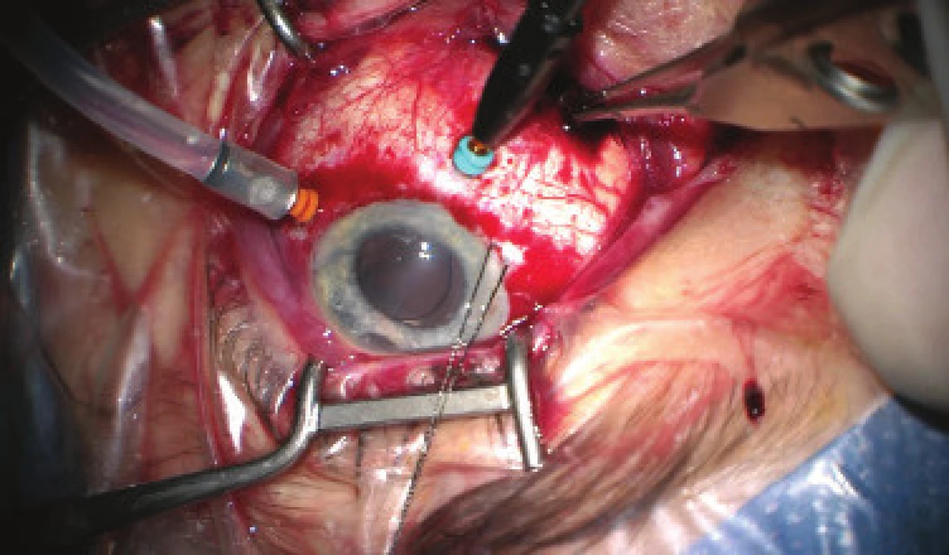 Progressive evacuation of blood from second sclerotomy
(forceps inserted into wound), after disappearance
of ablation behind IOL 23G infusion inserted in region of
pars plicata (orange port) and 25G light (Chandelier, blue
port) for monitoring of the ocular fundus with display system
of microscope (Zeiss Resight). Auxiliary traction suture
inserted into the region of limbus in no. 8, evident decentration
of IOL. Image from perioperative video – from surgeon’s
view