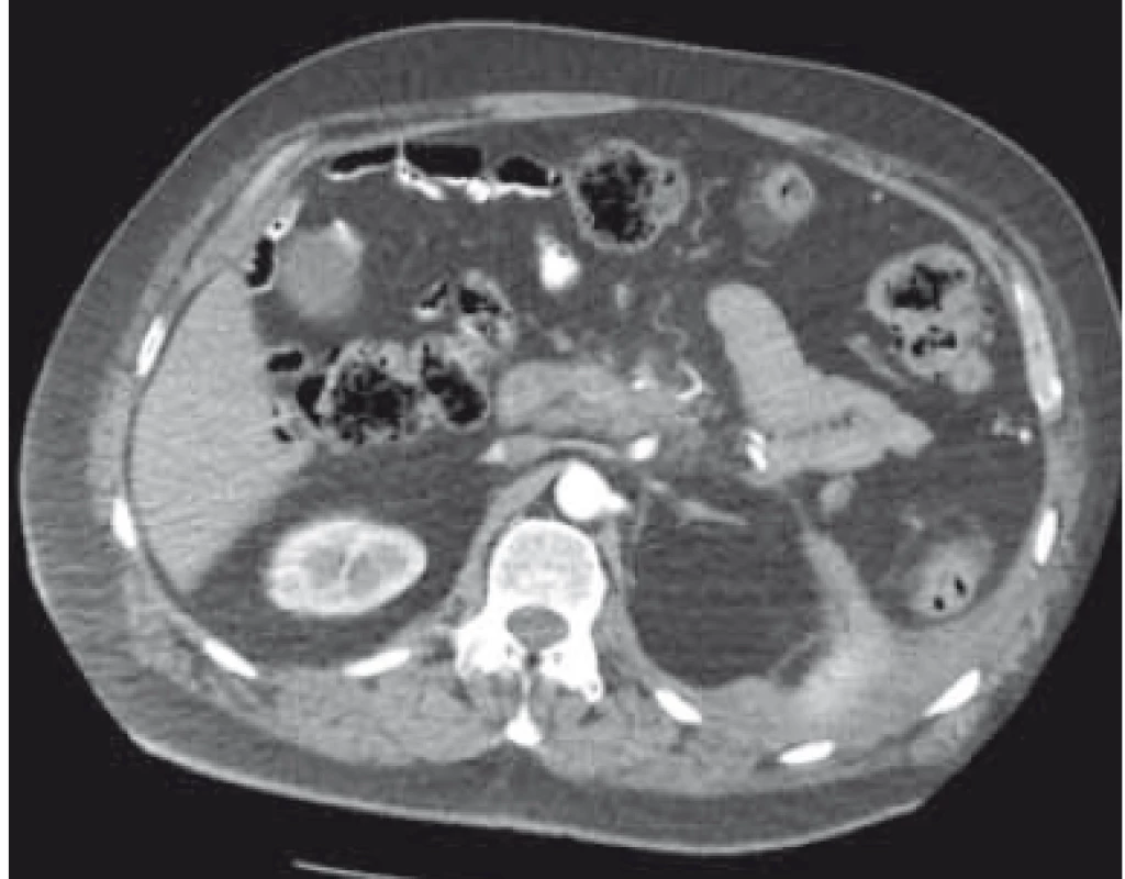 CT břicha – kompletní regrese
ohraničené pankreatické nekrózy po
endoskopické drenáži.<br>
Fig. 7. Abdomen CT – complete regression
of walled-off pancreatic necrosis
after endoscopic drainage.