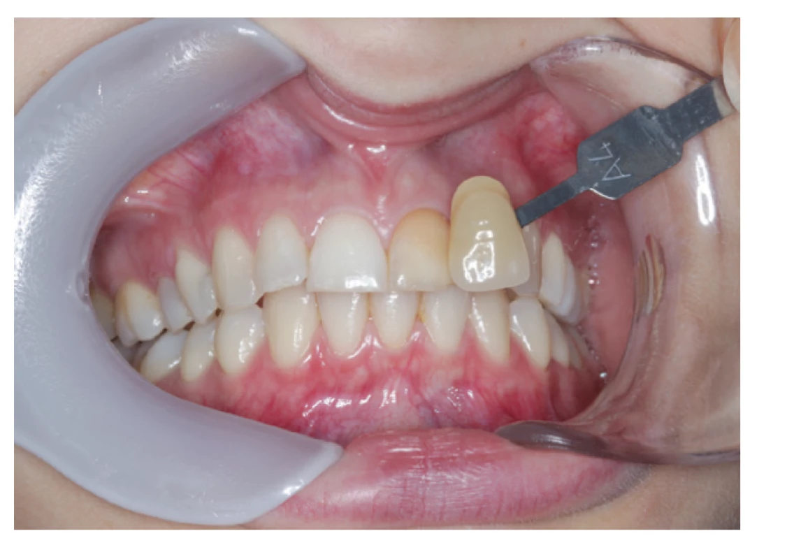 Zub zafarbený
zinkoxideugenolovým
sealerom<br>
Fig. 1
Tooth discolored
by zinc-oxide eugenol based
sealer