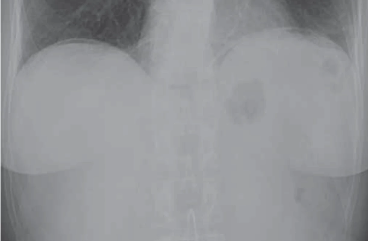 Na RTG snímku břicha vestoje, 12. den po CT kolografi
i, je patrný již jen reziduální lem volného plynu pod
bránicí. <br>
Fig. 5. Upright X-ray of abdomen 12 days after CT colonography
is visible residual rim of free air in subfrenic space.