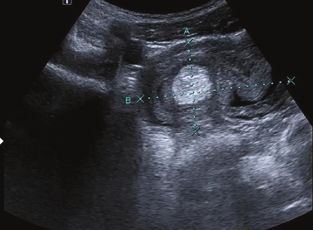 Abdominal USG with a target-like mass – intussusception
(transverse section, axis A= 4.2 cm, axis B=7.2
cm), hyperechogenic polypoid structure intraluminally