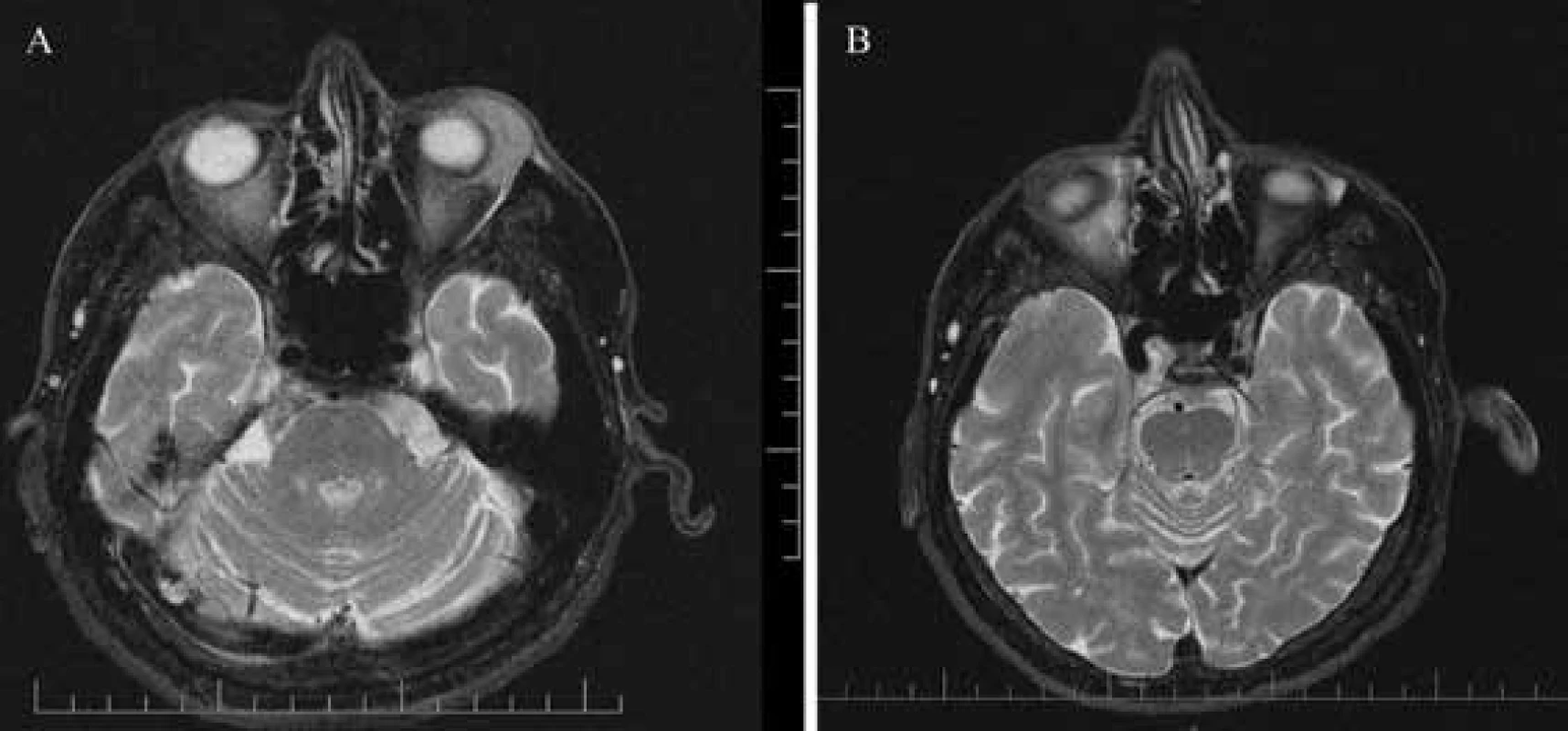 Pacient 2 - magnetická rezonancia hlavy: axiálny rez, T2 váženie, lymfóm dolnej mihalnice vľavo <br>A) v čase diagnostiky 01/2019 <br>B) po chemoterapeutickej a imunologickej liečbe 11/2019
