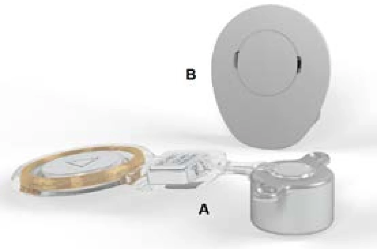 Systém BoneBridge:<br>
A) implantabilní aktivní vnitřní část<br>
B) externí audioprocesor SAMBA

