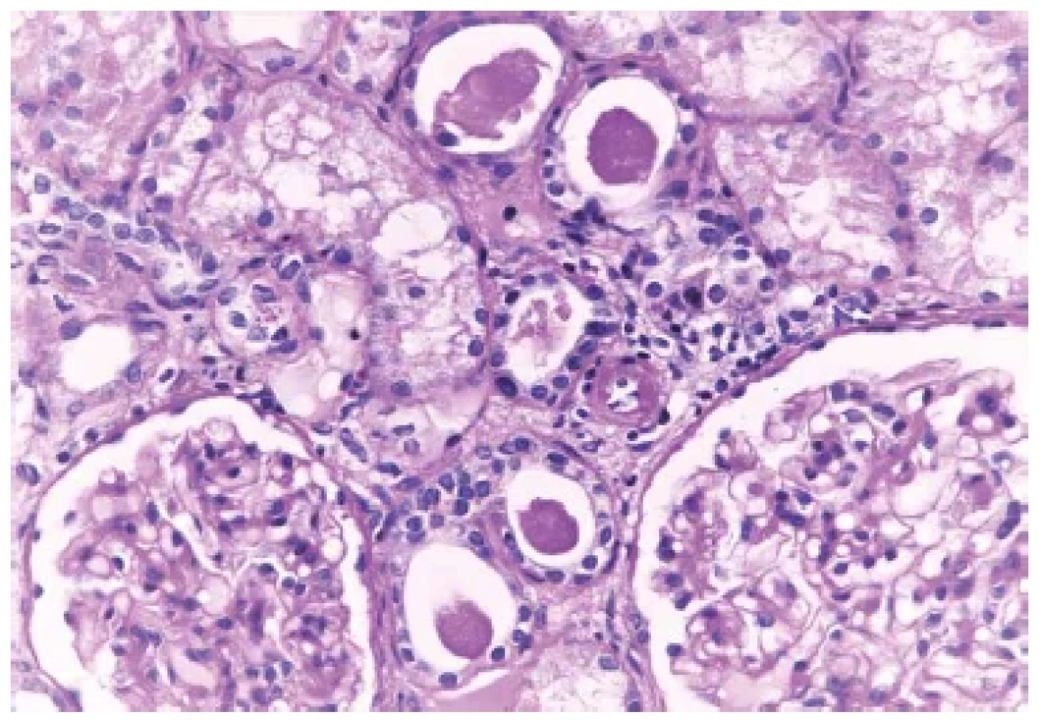 Přiměřené glomeruly a skupina kanálků s PAS pozitivními vločkovitými
válci s mírným zánětem v okolí. Barveno PASem (zvětšení 200x).