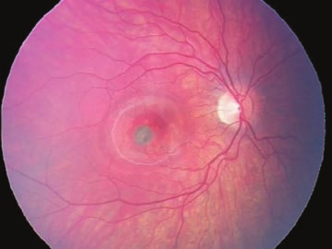 Initial fundus photography OD: choroidal neovascularisation
in juxtafoveolar localisation with significant haemorrhagic serous
edema