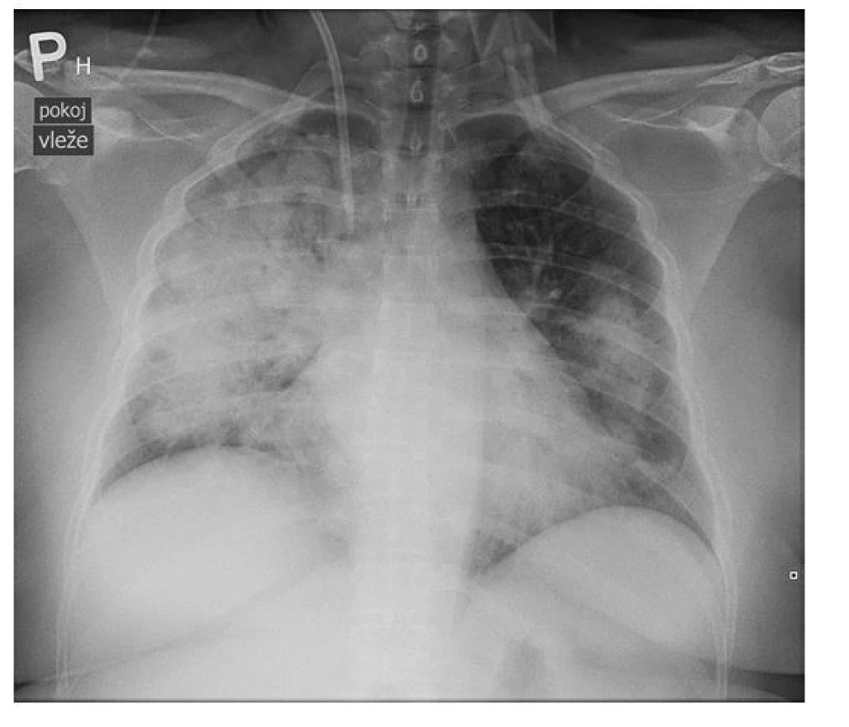 Radiografické vyšetření plic pacientky s nálezem masivní bilaterální
infiltrace (archiv autorky a Kliniky radiologie FN Olomouc)