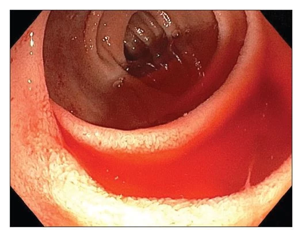 Obraz krvácející angiodysplazie v oblasti proximálního jejuna.