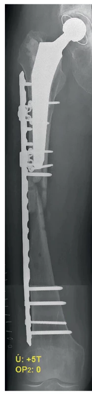 Pooperační RTG – 1. reoperace<br>
Fig. 4: Postoperative X-ray – the 1st revision surgery