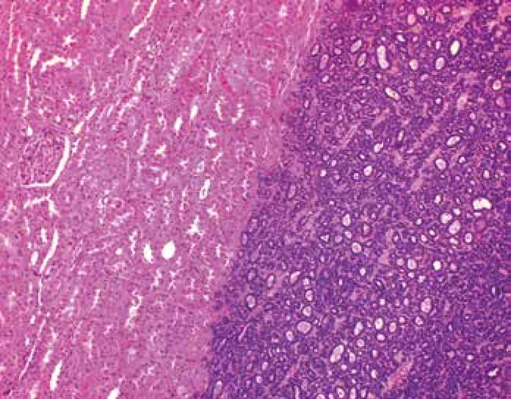 MA is unencapsulated and sharply demarcated from the surrounding
renal parenchyma (HE, 100x).