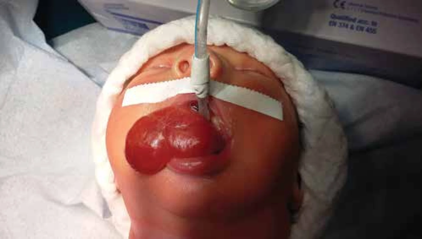 Novorozenec s objemným epulisem dutiny ústní.<br>
Fig. 1. Case of newborn with a really big epulis.