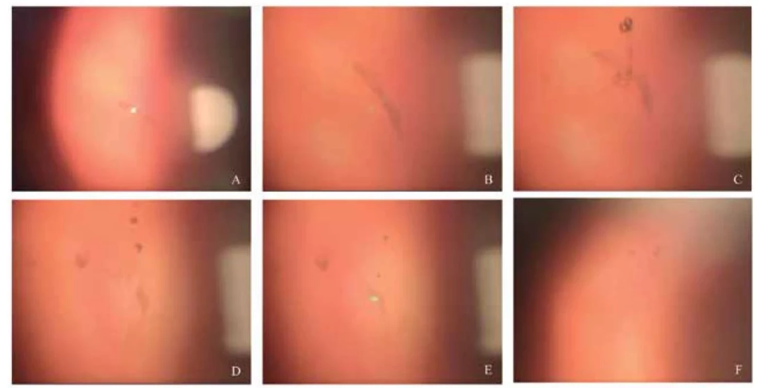 Průběh laserové vitreolýzy u non PVD typu zákalu. (A) opacita (B) opacita zvětšení 16x (C, D, E) redukce opacity
v průběhu zákroku (F) Foto na konci zákroku<br>
PVD–posterior vitreous detachment