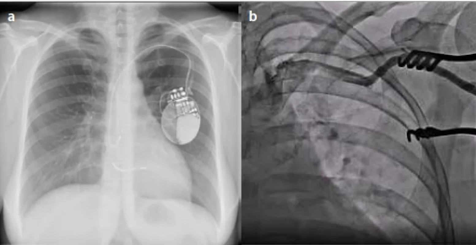 Venografie vena subclavia l. sin. a uložení implantabilního kardioverter-defibrilátoru s vodiči v pravé síni a pravé komoře. Zdroj: archiv autora. Fig. 1. Venography of the subclavian vein l. sin. and placement of an implantable cardioverter-defibrillator with leads in the right atrium and right ventricle. Source: 
author’s archive