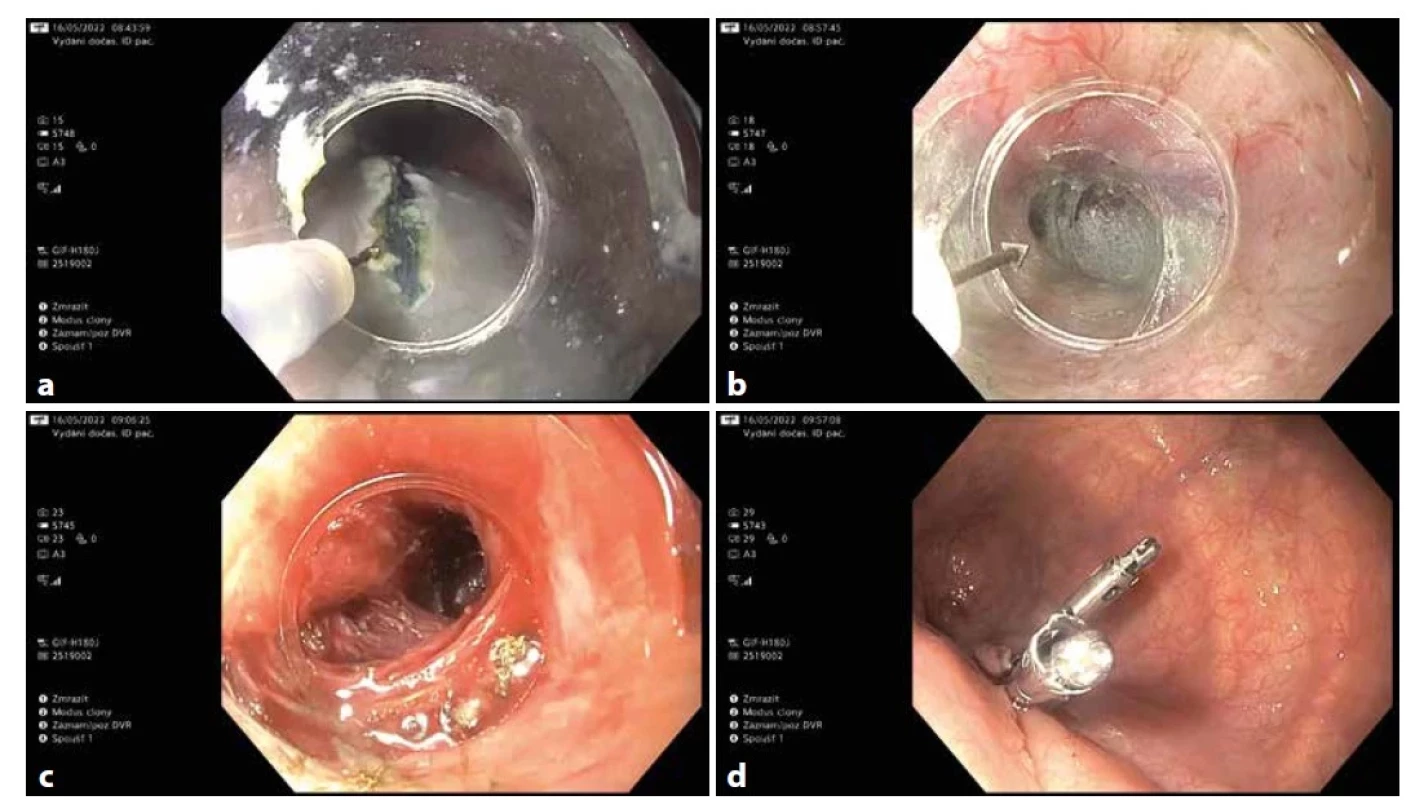 POEM a) incize, b) tunelizace, c) myotomie, d) uzavření incize klipy<br>
Fig. 3: POEM a) incision, b) tuneling, c) myotomy, d) closure by clips