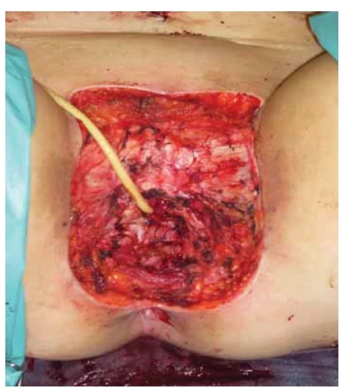Stav po vulvektomii extendované do genitofemorálních
rýh.<br>
Fig. 2. Condition after vulvectomy extended into the genitofemoral
grooves.