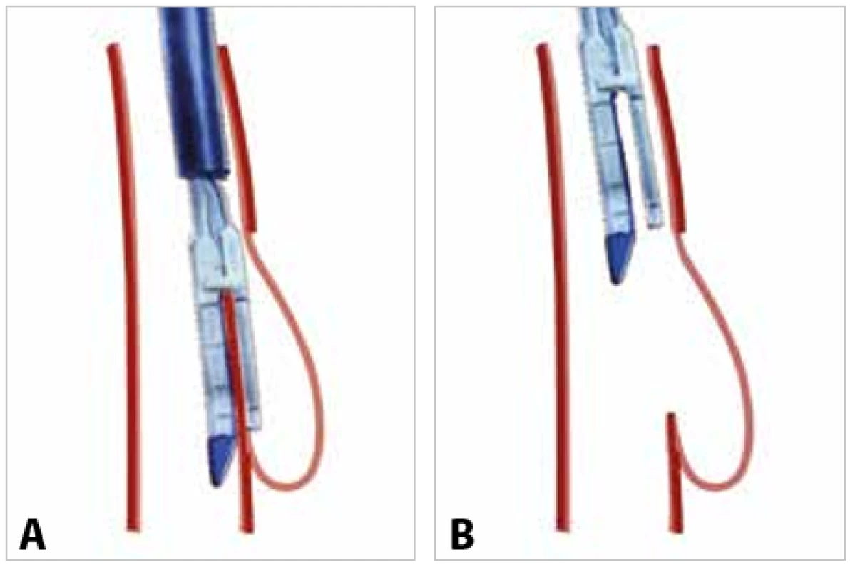 Transorální endoskopická staplerová ezofagodivertikulotomie – schéma A) naložení stapleru, B) stav po disekci septa <br>Fig. 3: Transoral endoscopic stapler oesophagodiverticulotomy – the scheme: A) loading of the stapler; B) situation after septum dissection 