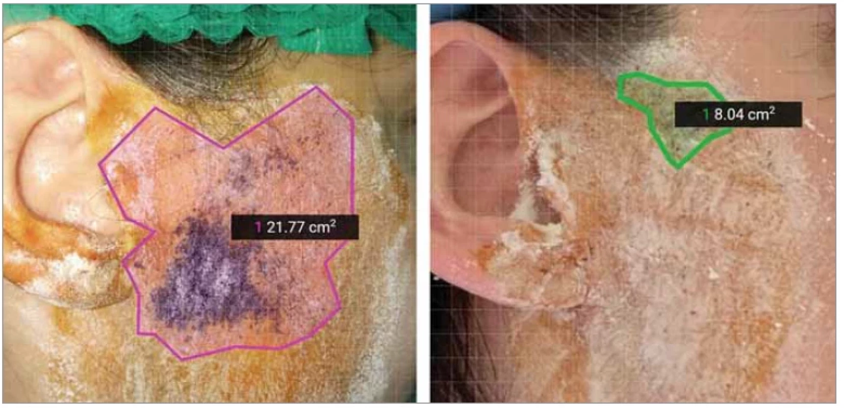 Porovnání výsledků Minorova testu pacienta 1. Vlevo před aplikací BTXA, vpravo po aplikaci BTXA. <br> 
Fig. 3. Comparison of the results of Minor’s test of Patient 1. Left before BTXA application, right after BTXA application.