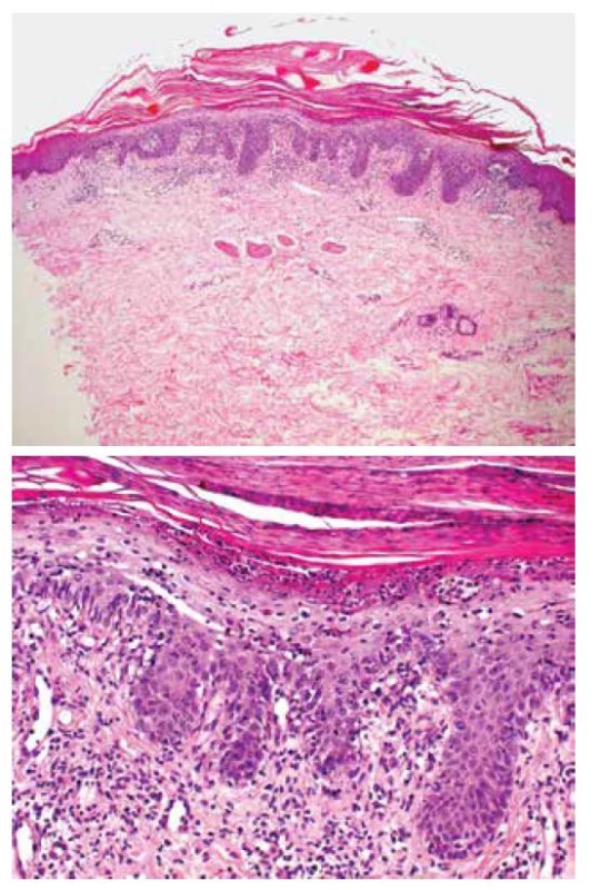 Superficiální dermatitida připouštějící diagnózu
psoriázy<br>
a) zvětšení 40x<br>
b) zvětšení 200x (H-E)