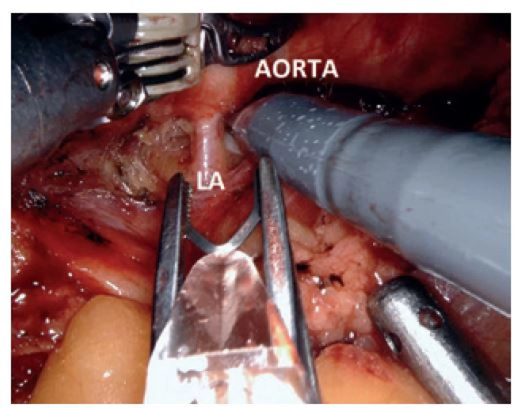 Robotické naložení klipu na lumbální tepnu (LA)
při řešení endoleaku 2. typu<br>
Fig. 2: Type 2 endoleak treatment – robotic lumbar artery
(LA) clipping