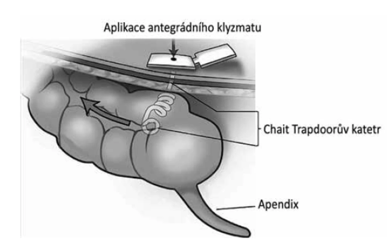 LAPEC – schéma výkonu<br>
Fig. 7: LAPEC – scheme of the procedure