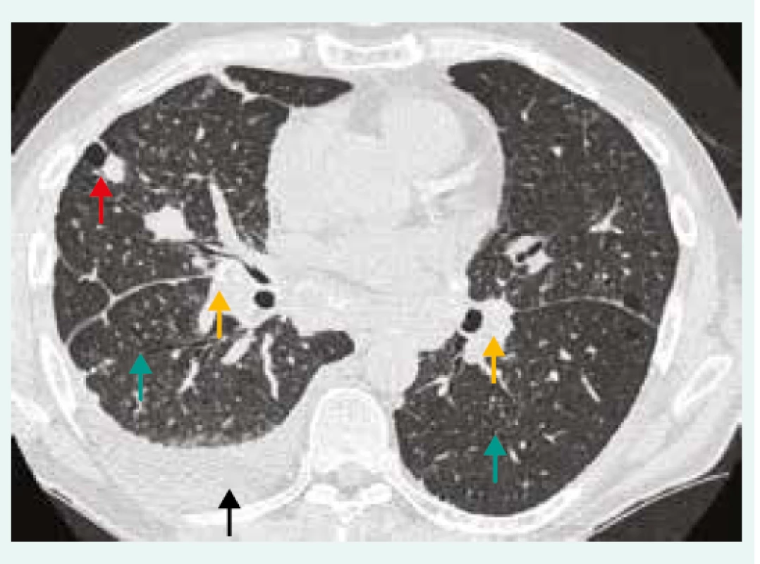 HRCT hrudníku pacienta se silikózou, pneumonií
s pleurální reakcí a podezřením na CD4+
lymfocytopenie. Oboustranná lymfadenopatie
s kalcifikacemi (žlutá šipka), bronchioloektazie/
bronchiektazie (zelená šipka), nodularity
(červená šipka), pleurální výpotek (černá šipka).<br>
Z archivu autorky