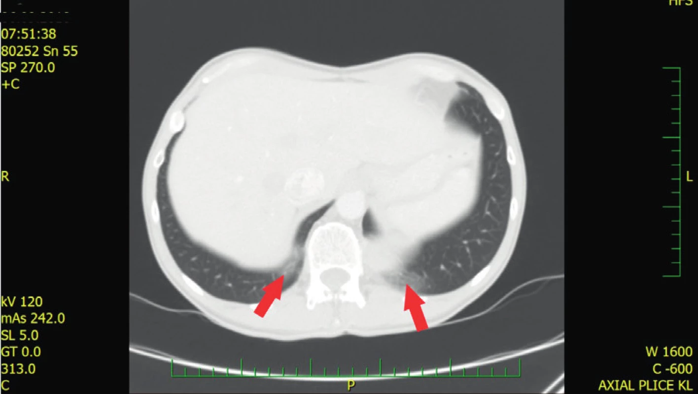 HRCT (high resolution computed tomography) plic pacienta
s GER
Dorzobazální drobné opacity mléčného skla (ground glass),
které odpovídají aspiraci při refluxu. Nález nemá charakter
intersticiálního plicního postižení (z archivu Revmatologického
ústavu)